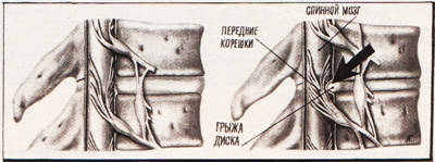 Изображение позвоночника в разрезе при грудном радикулите