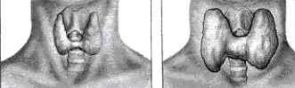 Изображение нормальной щитовидной железы (слева) и увеличенной при диффузном токсическом зобе