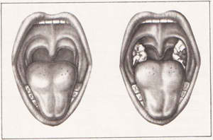Фото дифтерии, слева — миндалины здорового ребенка; справа — больного дифтерией: на миндалинах серовато-белые налеты с гладкой поверхностью и четко очерченными краями.
