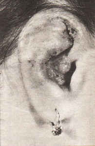 Фото проявления экземы наружного уха, кожа шелушится, краснеет, покрывается чешуйками, на ней образуются корки, трещинки