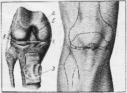 Коленный сустав: а - бедренная кость; б - крестообразные связки; в - латеральный мениск; г - медиальный мениск; д - надколенник.